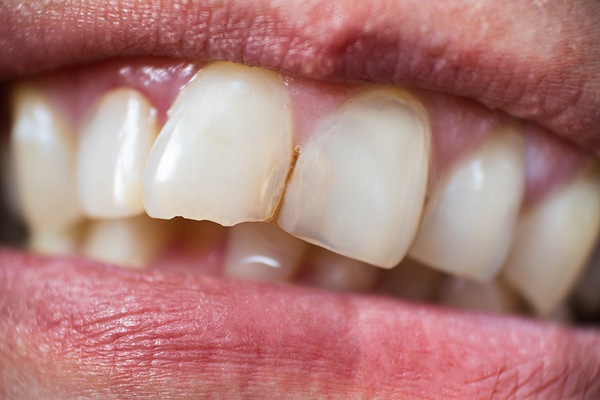 Tips For Preventing Chipped Teeth