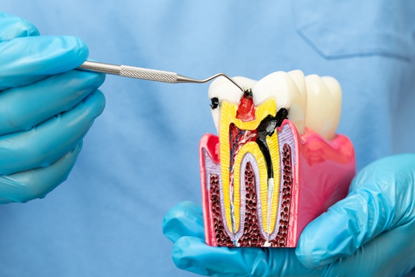 How Does A Non Surgical Root Canal Work?