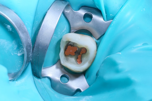 When You Should Consult A Root Canal Specialist