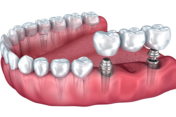 Teeth Replacement Options Using Dental Implants